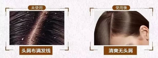 告別脫發(fā)、頭皮屑與頭發(fā)稀少的煩惱，重塑烏黑濃密的秀發(fā)